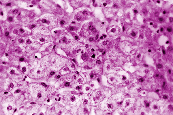 Liver Tissue With Viral Hepatitis Ver1