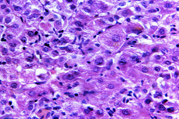 Liver Tissue With Acute Infectious Hepatitis