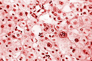 Liver Tissue With Viral Hepatitis Ver3